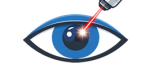 Lasik5