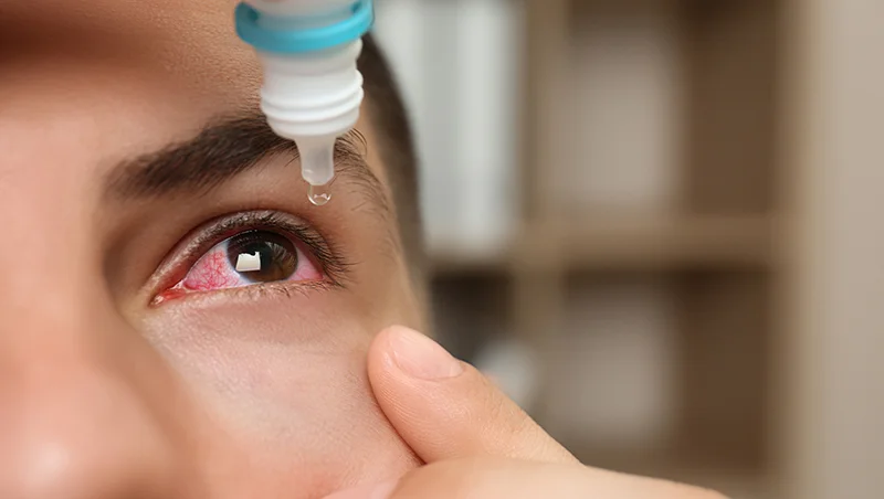 How to Treat Eye Flu: Symptoms, Causes, and Effective Remedies How to Treat Eye Flu: Symptoms, Causes, and Effective Remedies